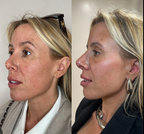 Veserra Therapy Mask