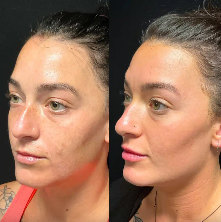 Veserra Therapy Mask